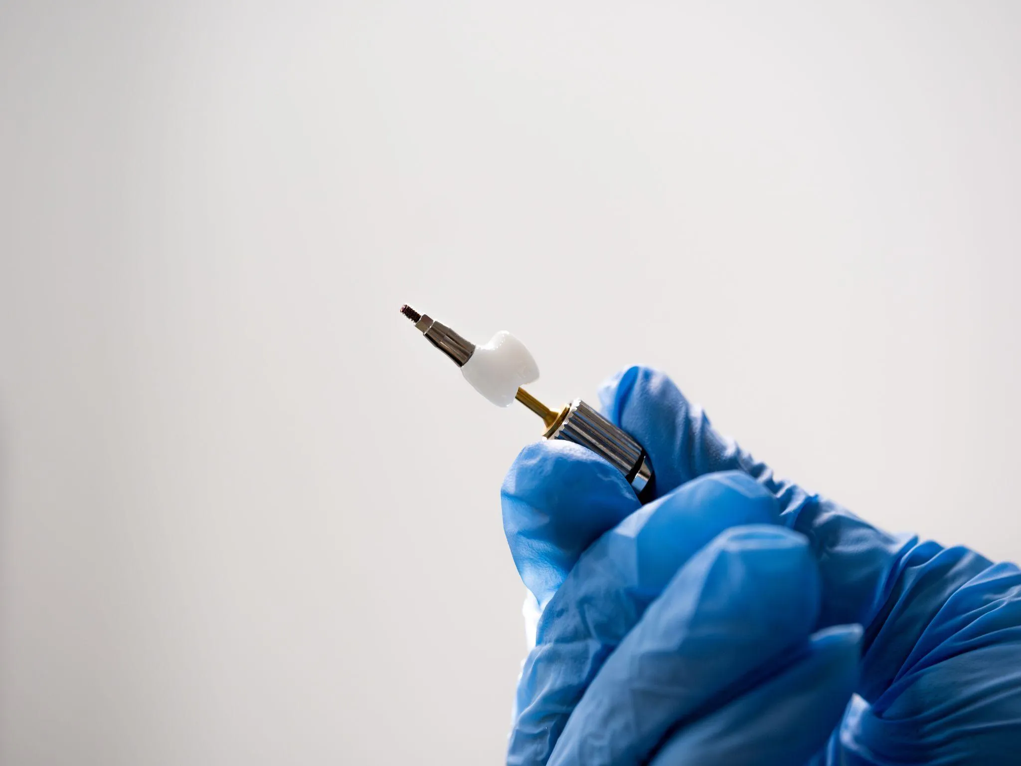 インプラントの寿命は何年？寿命を延ばす方法と再治療まで解説