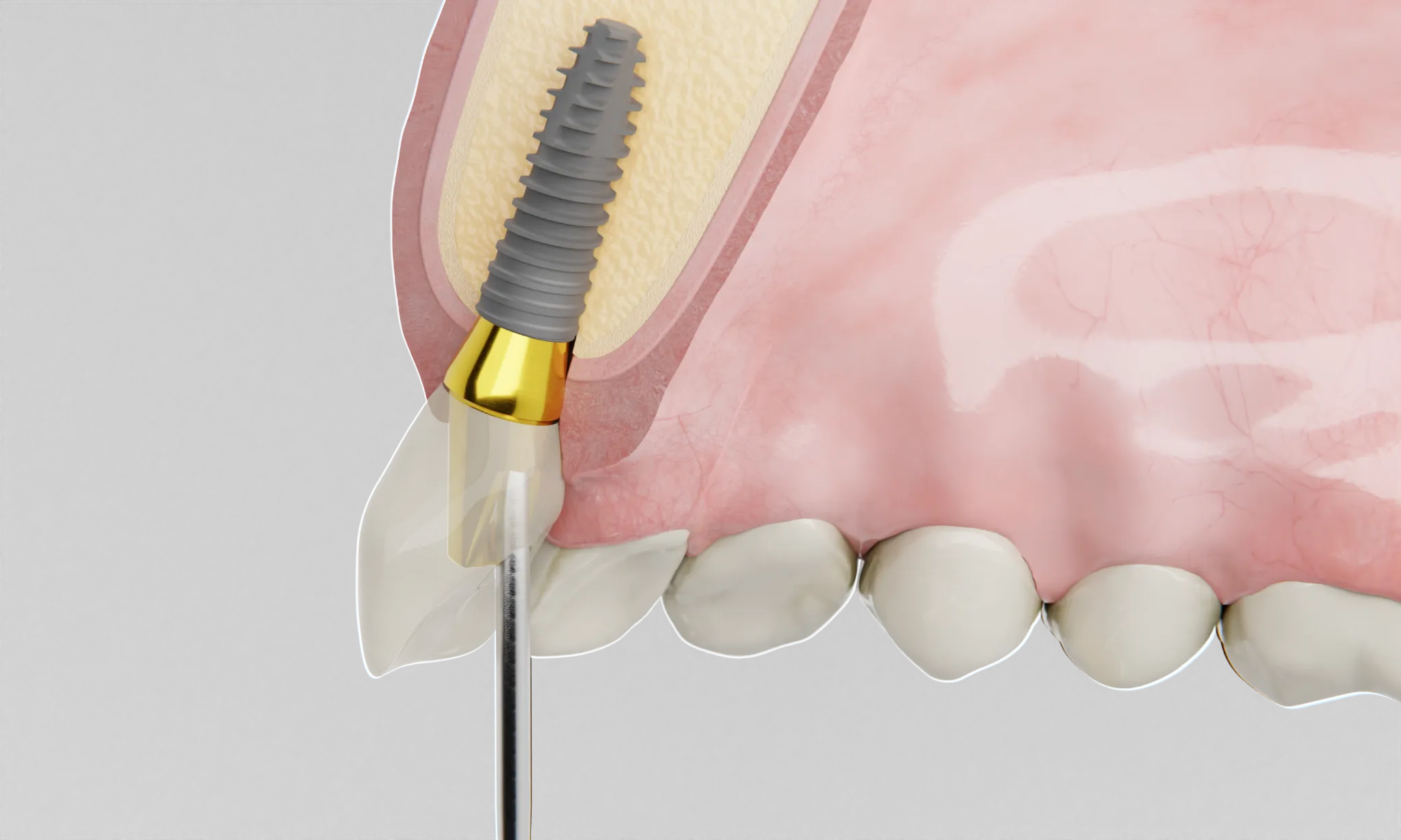 インプラント周囲炎の症状や原因を解説｜セルフチェックで早期発見を
